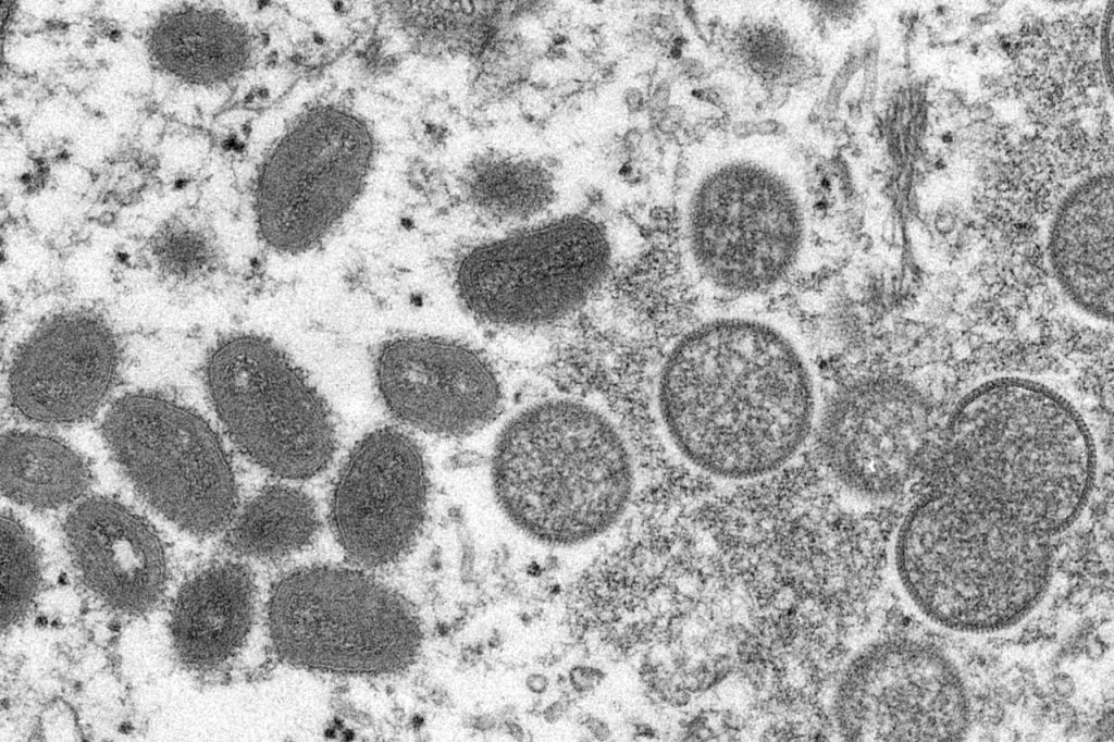 First probable monkeypox cases reported in Missouri, Indiana