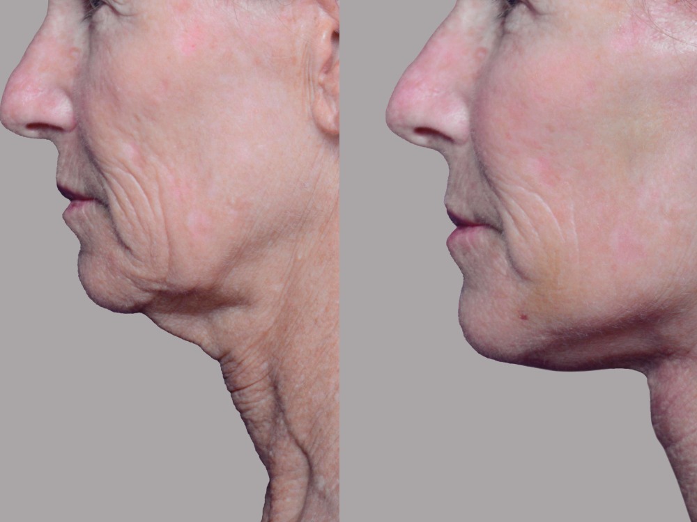 The Innovative Technique that Gives Former Facelift Patients Their Results Back