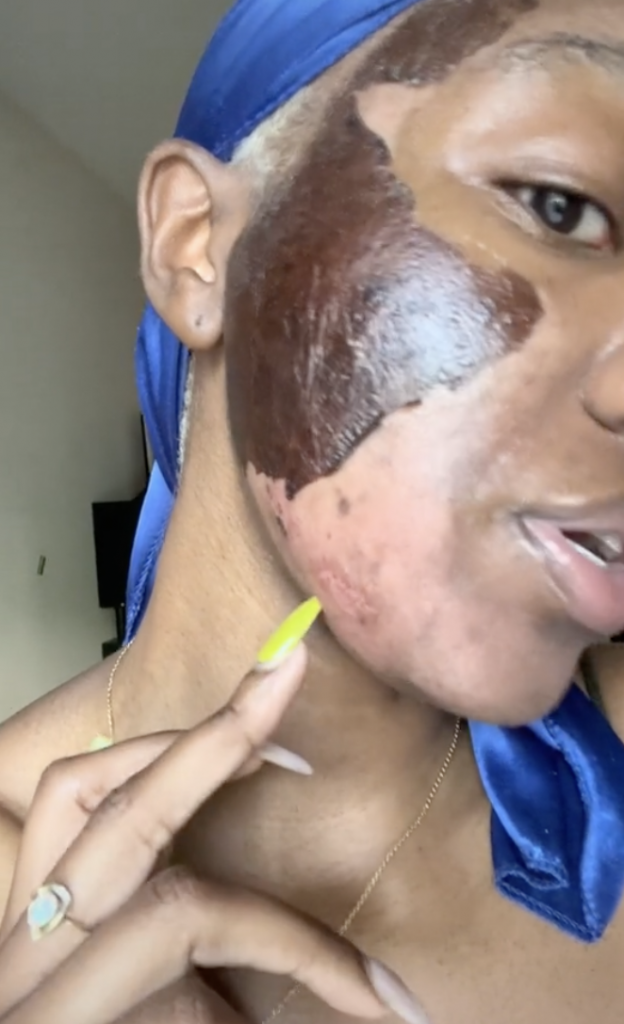 This Woman’s Scary Result Shows the Dangers of a Chemical Peel Gone Wrong