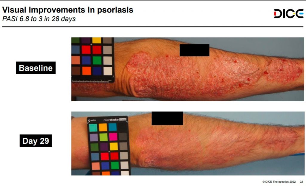 A biologic’s efficacy in a pill: Dice posts first human data for oral psoriasis med – MedCity News