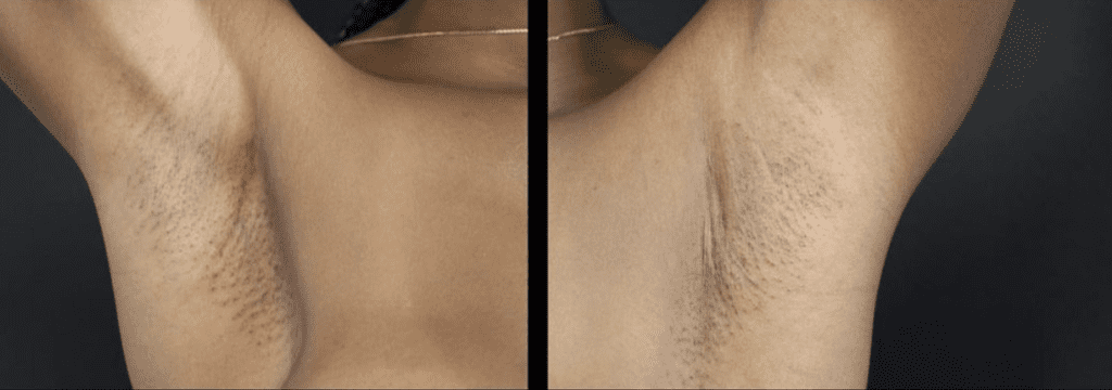 This Breast Surgery Technique Promises No Visible Scars